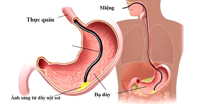 Nội soi dạ dày qua đường miệng