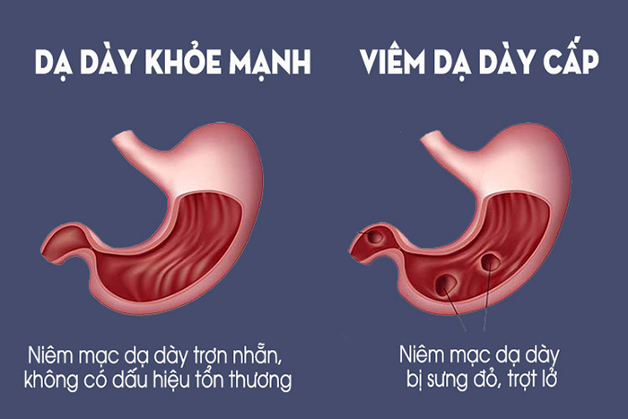 Nội soi dạ dày có thể phát hiện bệnh viêm dạ dày