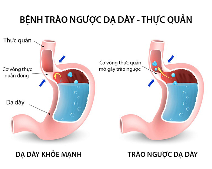 Bệnh trào ngược dạ dày - thực quản