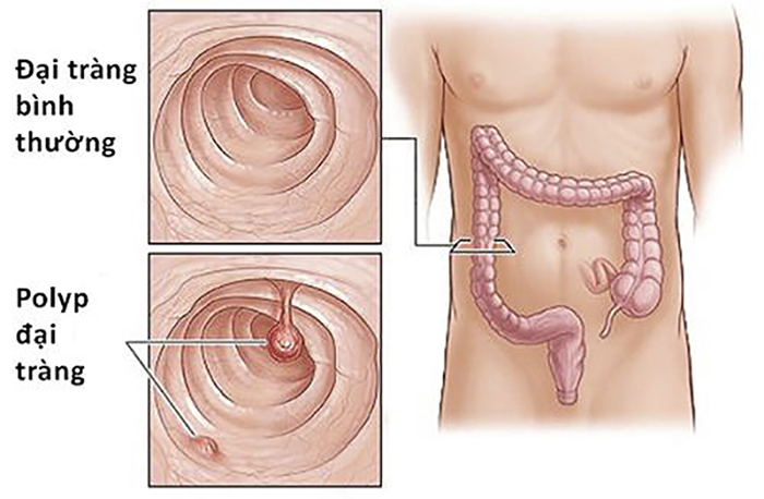 Polyp đại tràng có thể tiến triển gây ung thư đại tràng