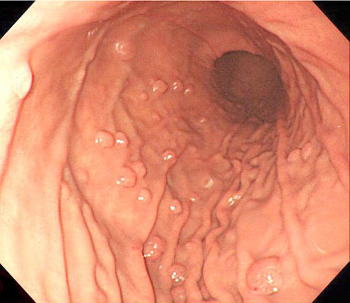 Một số loại polyp dạ dày có khả năng tiến triển ác tính