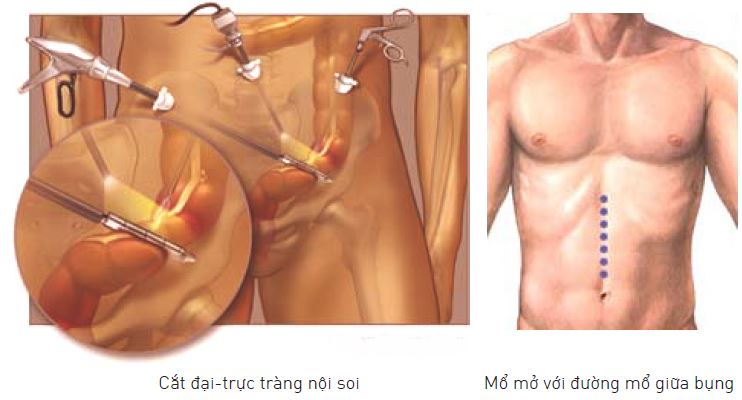 Bác sĩ thực hiện thao tác cắt nối đoạn đại tràng bằng máy