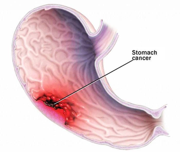 Thủng dạ dày là tác dụng phụ rất hiếm gặp khi nội soi dạ dày.
