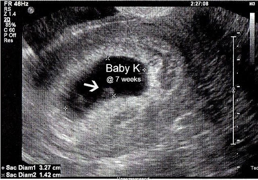 Tim thai yếu 3 tháng đầu là dấu hiệu cảnh báo nguy hiểm của thai nhi
