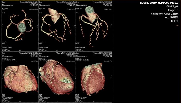 Kỹ thuật chụp MSCT mạch vành cho hình ảnh rõ nét, độ phân giải hình ảnh cao, tái tạo không gian 3 chiều.