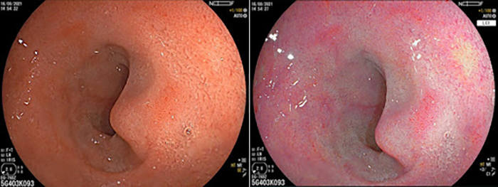 Hình ảnh nội soi với ánh sáng trắng và nhuộm màu LCI làm nổi bật tổn thương viêm màu đỏ