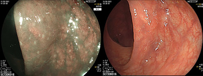 Hình ảnh nội soi nhuộm màu BLI với nhiều tổn thương viêm (chấm trắng)