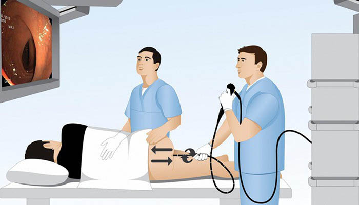Không phải tất cả các trường hợp bị đau đại tràng đều được chỉ định nội soi để kiểm tra tình trạng bệnh