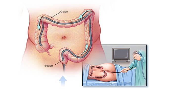 Phương pháp nội soi đại tràng KHÔNG ĐAU