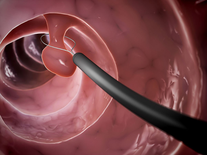 Kỹ thuật nội soi có thể giúp phát hiện ra sự xuất hiện của polyp đại tràng
