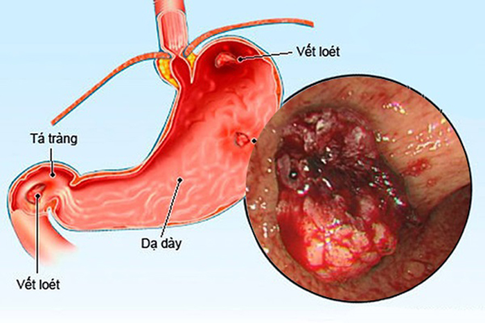 Bệnh viêm loét dạ dày tá tràng có thể gây ung thư sớm