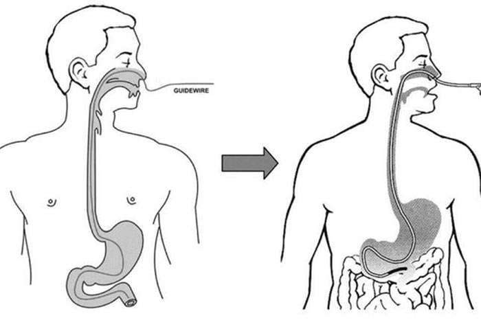 Phương pháp nội soi dạ dày qua đường mũi ít gây đau cho bệnh hơn