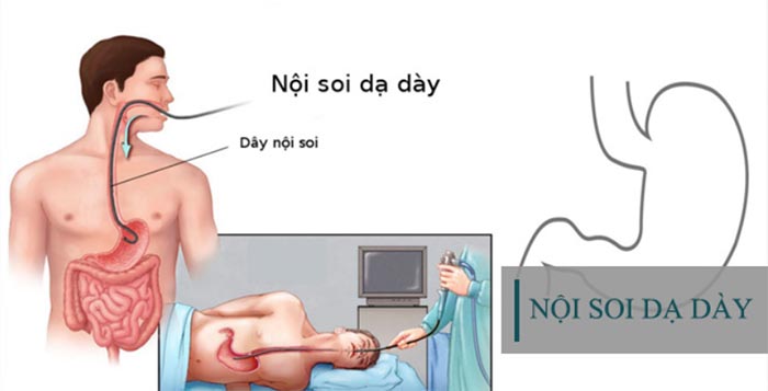 Nội soi dạ dày có bị lây bệnh không? – Chuyên gia giải đáp