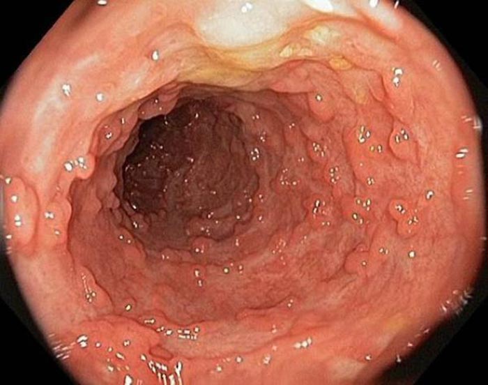 Khoảng cách giữa 2 lần nội soi dạ dày cho người bị đa polyp tuyến gia đình ít nhất là 3 năm