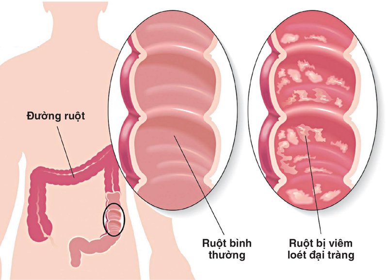 Đau bụng vùng dạ dày có thể là biểu hiện của viêm loét đại tràng