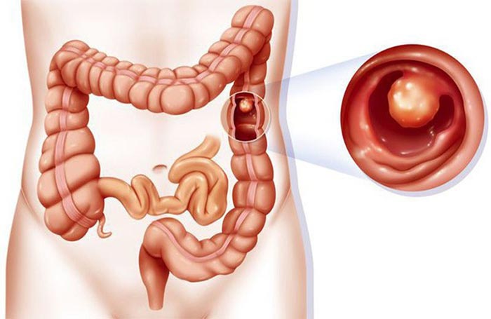 Người đã phát hiện mắc polyp đại tràng hoặc đã cắt bỏ polyp đại tràng nên chụp nội soi đại tràng ảo để tầm soát ung thư.