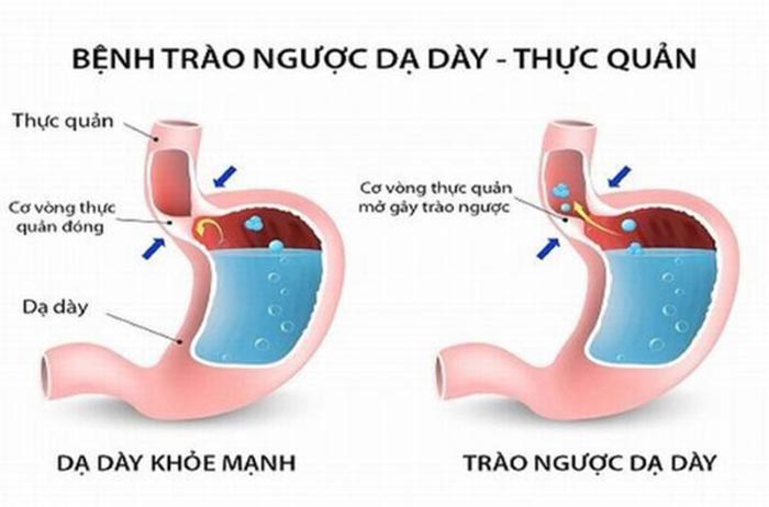 Trào ngược dạ dày thực quản xảy ra khi acid dạ dày trào ngược gây tổn thương thực quản