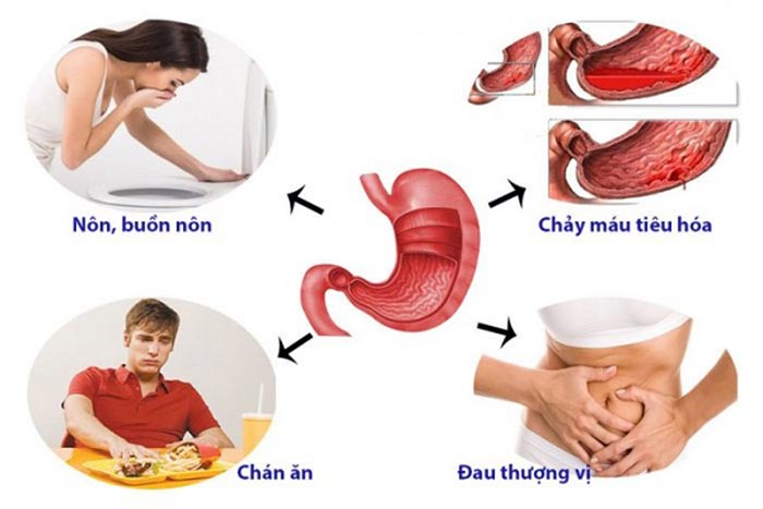Người bệnh có các triệu chứng buồn nôn, chán ăn, đau vùng thượng vị thì nên nội soi dạ dày