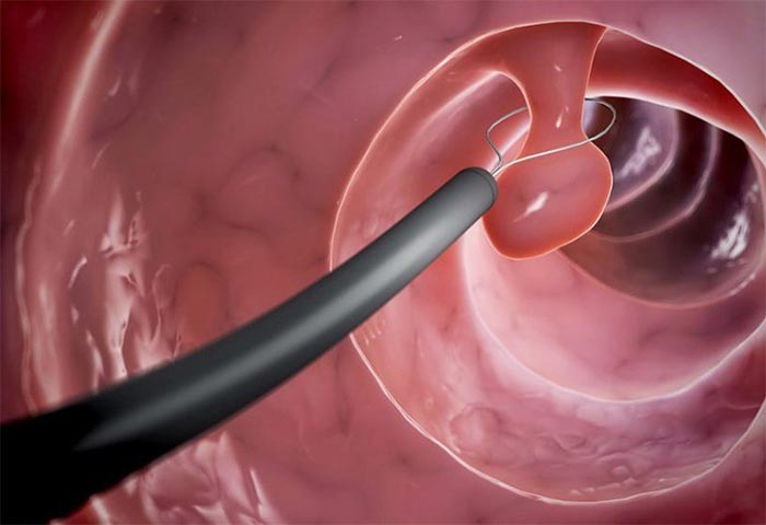 Nội soi dạ dày sinh thiết giúp các bác sĩ loại bỏ được các tổn thương polyp nhỏ trong quá trình nội soi