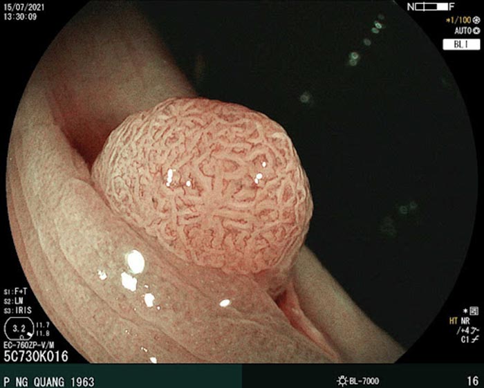 Hình ảnh rõ nét về tổn thương trên niêm mạc dạ dày được thực hiện bởi máy nội soi BL7000 tại MEDIPLUS