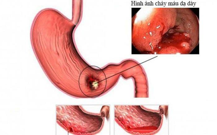 Xuất huyết dạ dày là một bệnh cấp cứu nội khoa và bác sĩ có thể chỉ định can thiệp nội soi để cầm máu