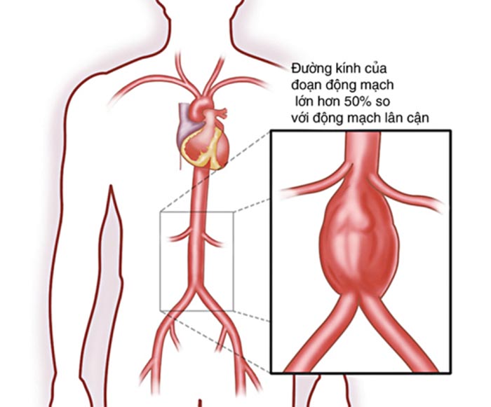 Bệnh nhân có túi phình lớn ở động mạch chủ thường không nên nội soi dạ dày