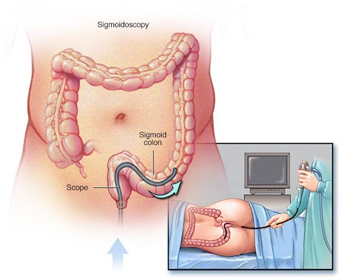 Hình ảnh minh họa nội soi đại tràng sigma