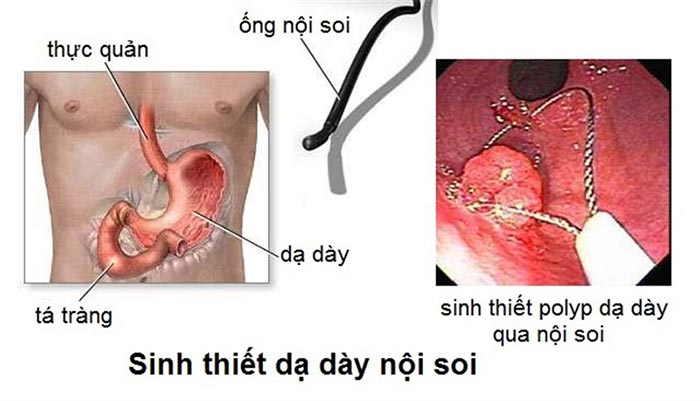 Hình minh họa phương pháp nội soi dạ dày có sinh thiết