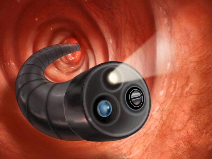 Một ống mềm nội soi có gắn đèn chiếu sáng và camera đưa vào đường miệng xuống thực quản để quan sát được dạ dày
