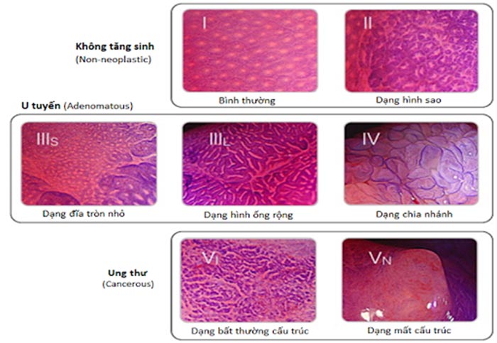 Bác sĩ có thể xác định mức độ xâm lấn và chẩn đoán giai đoạn bệnh dựa trên phân loại KUDO thông qua nội soi phóng đại nhuộm màu Crystal