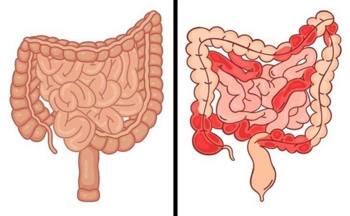 Nội soi đường tiêu hóa bằng viên nang không thể tiến hành các thủ thuật can thiệp