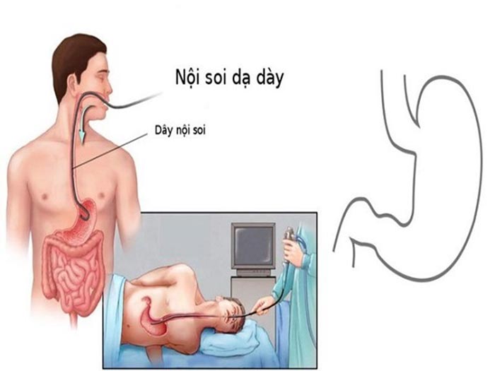 Nội soi dạ dày qua đường miệng không mê có thể gây chút khó chịu vùng cổ họng
