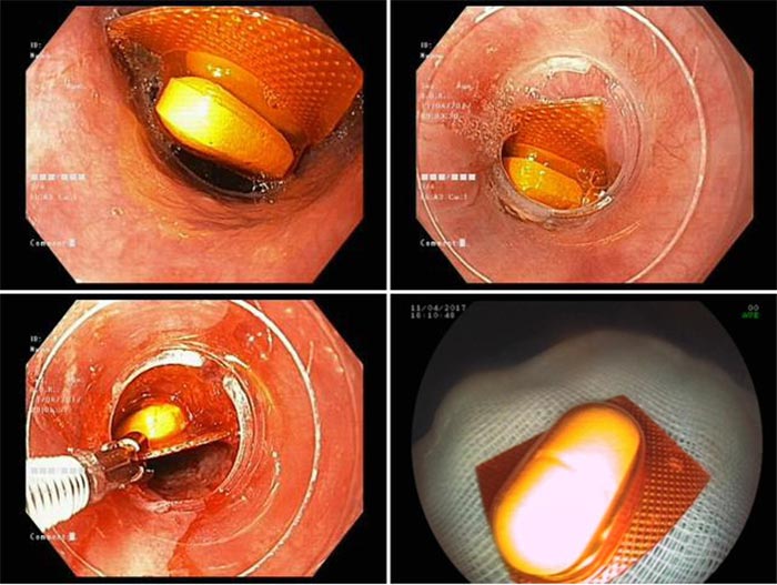 Hình ảnh bác sĩ lấy viên thuốc ra khỏi dạ dày thông qua nội soi