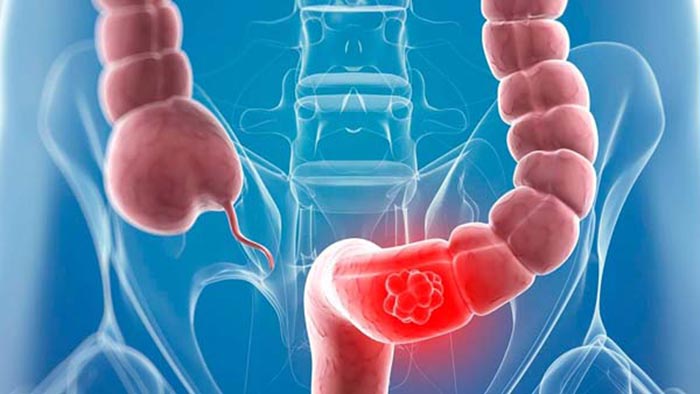 Nội soi đại tràng sigma sẽ phát hiện được những bất thường ở khu vực đại tràng sigma 