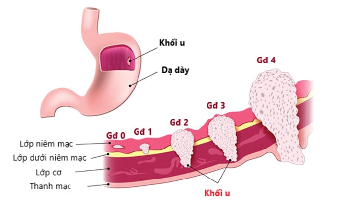 Nội soi có thể tầm soát ung thư dạ dày ở giai đoạn sớm để tránh tình trạng khối u ác tính di căn