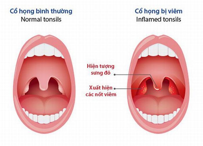 Ống nội soi có thể va chạm gây tổn thương, trầy xước niêm mạc họng gây đau họng đối với người đang bị viêm họng