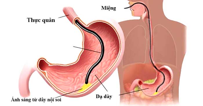 Sử dụng ống nội soi cứng có thể gây ma sát tổn thương niêm mạc dạ dày