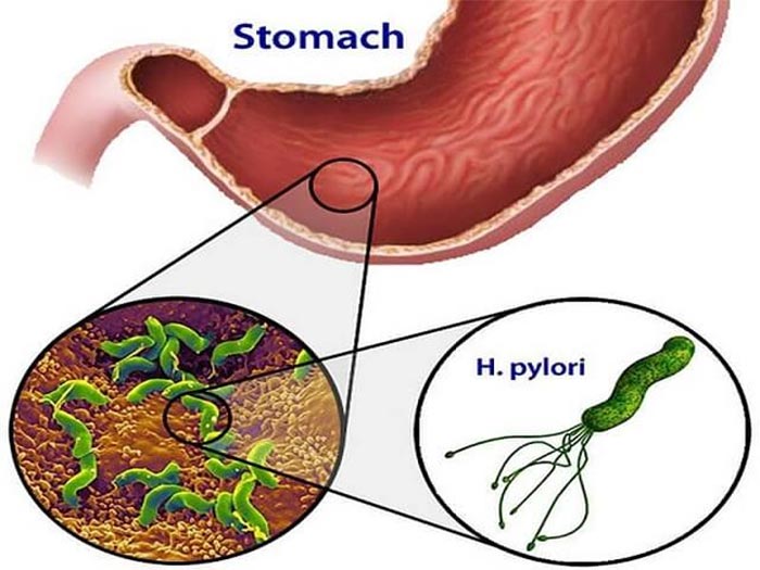 Vi khuẩn Hp tiết ra chất độc gây hại cho niêm mạc người bệnh, lâu dài có thể dẫn đến ung thư dạ dày