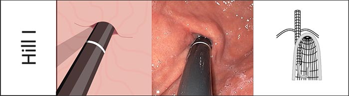 Hill I: Van nắp dạ dày thực quản dạng vách, luôn đóng chặt quanh ống nội soi