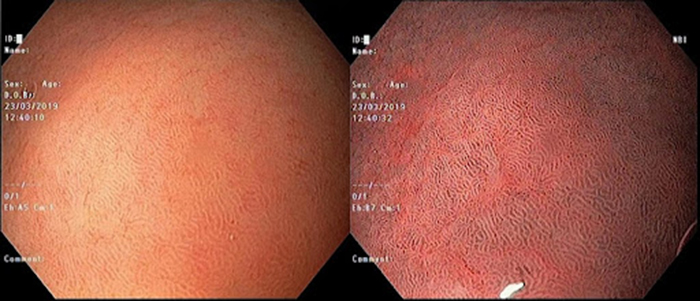 Hình ảnh niêm mạc dạ dày khi nội soi thường (hình trái) và nội soi nhuộm màu NBI (hình phải)
