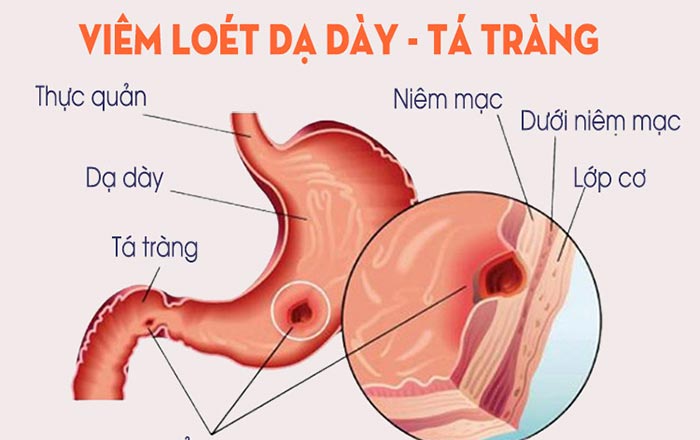 Viêm loét dạ dày tá tràng là bệnh lý xảy ra khi lớp niêm mạc của dạ dày, tá tràng bị  tổn thương, phá hủy