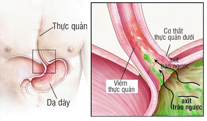 Niêm mạc thực quản sẽ bị ăn mòn, viêm loét khi bệnh trào ngược dạ dày không được chữa trị đúng cách và kịp thời