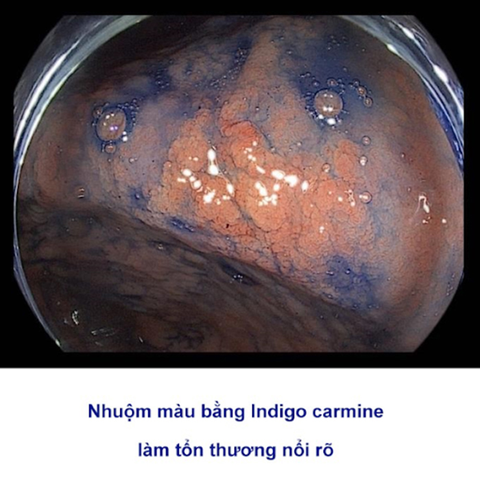 Các tổn thương nổi rõ khi nội soi nhuộm màu bằng Indigo carmine