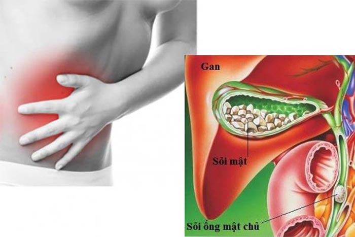 Sỏi mật khiến người bệnh gặp phải nhiều triệu chứng như: đau bụng, rối loạn tiêu hóa, sốt, ớn lạnh,... 