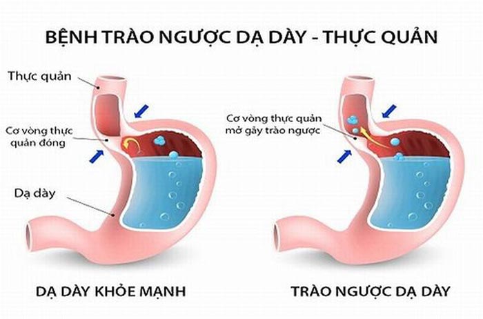 Trào ngược dạ dày thực quản là căn bệnh khiến dịch dạ dày trào ngược lên thực quản