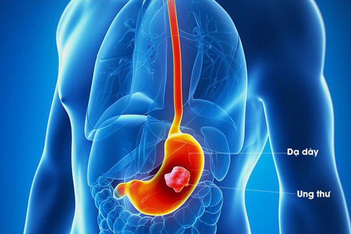 Ung thư dạ dày là căn bệnh xảy ra khi các tế bào của dạ dày phát triển đột biến, hình thành khối u