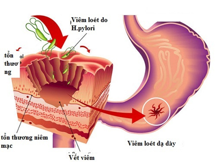 VIÊM DẠ DÀY MẠN TÍNH | 4 ĐIỀU CẦN BIẾT