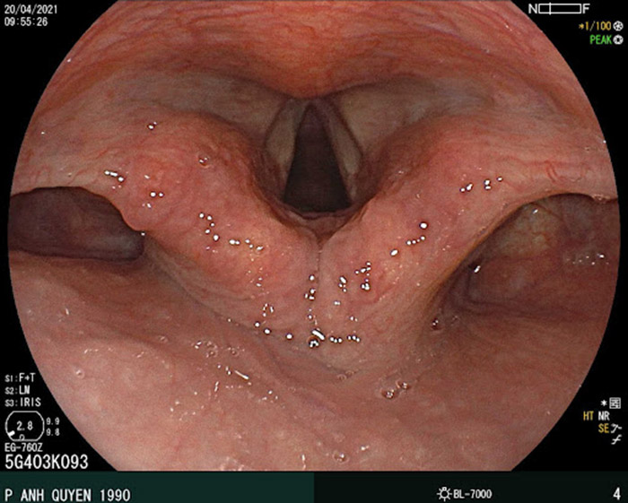  Hình ảnh ngã ba hầu họng khi nội soi thực quản dạ dày, điểm bắt đầu của thực quản ngay sau cơ thắt thực quản tại ngã ba hầu họng (Hình ảnh thực hiện tại Mediplus)