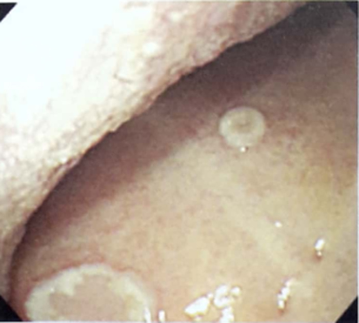 Hình ảnh nội soi thực quản bị tổn thương do herpes (Hình 1)