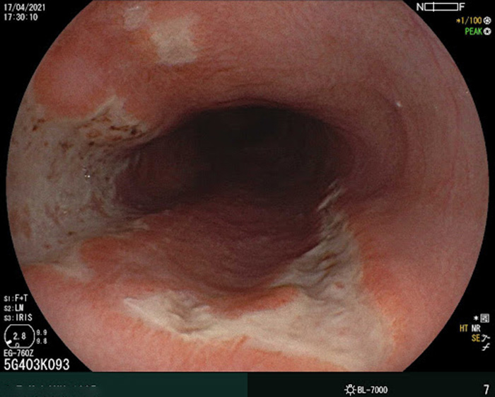 Hình ảnh nội soi thực quản có thể thấy các ổ loét (Hình 1)